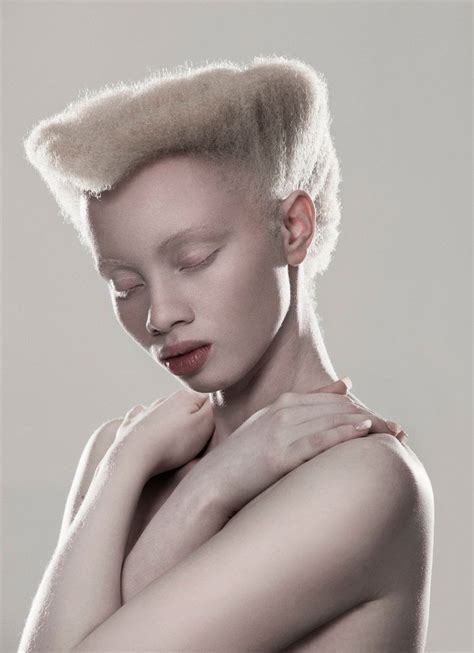 albino people naked|Albino .